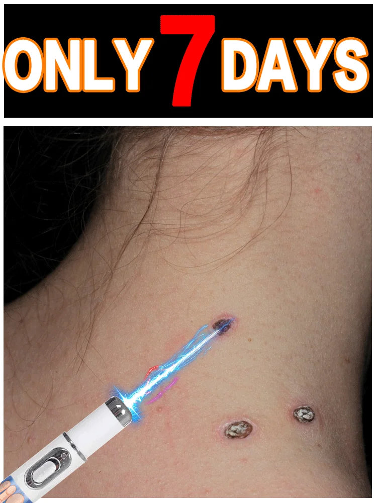 Latest upgraded blue light pen, best-selling wart care